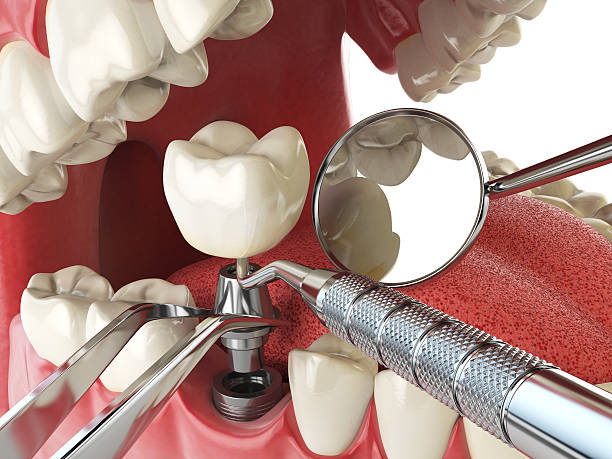 Best Emergency Tooth Extraction in Bardstown, KY